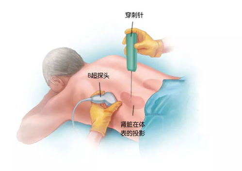 血浆置换加透析,被下病危通知书,都是因为红斑狼疮 果壳病人