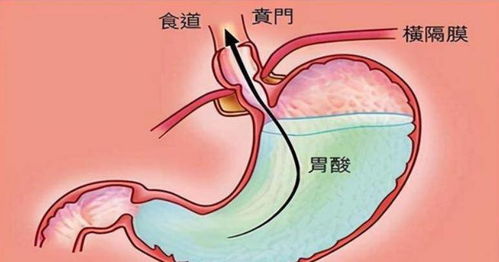 胃总是打饱嗝是怎么回事(胃总是打饱嗝是怎么回事儿)