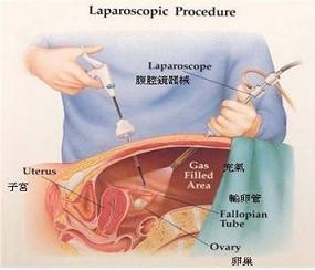 宫腹腔镜联合技术 
