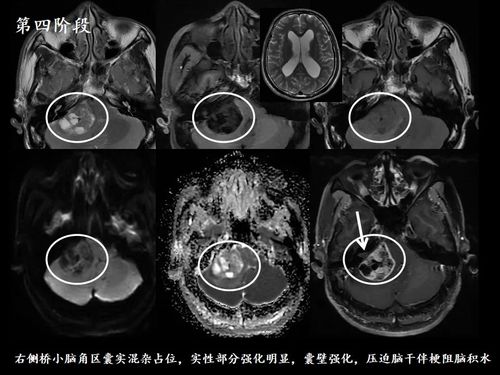 医影学堂 叫了几十年的听神经瘤,原来是错的