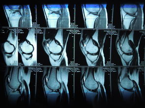 踢球受伤求助 请骨科专家来帮我看看我的左边膝盖核磁共振的片子 