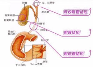 女性胆囊结石是什么原因