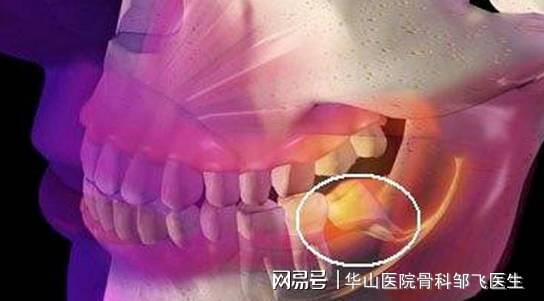 拔智齿也有生命危险 智齿到底要不要拔 这些情况要注意