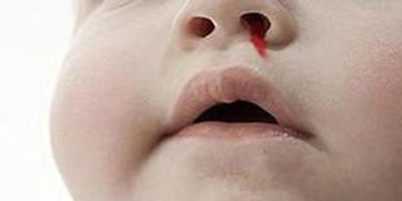 小孩子流鼻血(小孩子流鼻血的原因及处理方法)