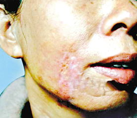 广州湛江发现一例人厚皮马拉色菌皮肤感染 