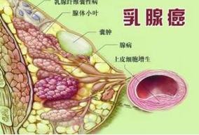 乳腺粘液腺癌 搜狗百科 