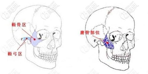 左右脸颧骨一高一低导致脸歪,颧骨高低不对称矫正方法都在这了