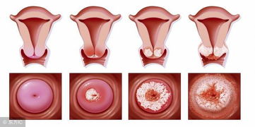 宫颈萎缩怎么调理过来,建议：宫颈萎缩，