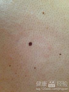 黑色素瘤早期症状图片(黑色素瘤的症状黑色素瘤早期图片)