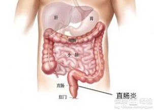 病人便秘溃疡性结直肠炎如何治疗