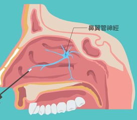 过敏性鼻炎翼管神经阻断术