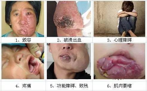 血管瘤丨出现这5种情况的血管瘤需要早治疗