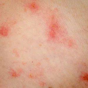 秋季皮肤瘙痒 起红疹,这是怎么回事