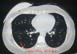 她乳腺癌手术后发现肺结节,才5毫米大,医生却建议手术 