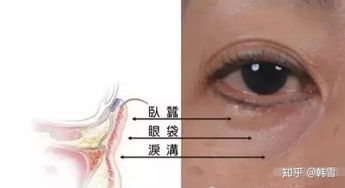 泪沟问题的解决方法全在这里,看你适合哪种方法 