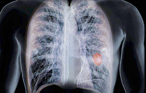 肺结核不张多发结节影误诊肺癌1例 