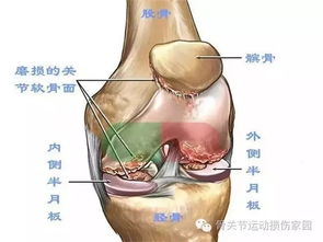 年纪不大,膝关节总是咔咔响是怎么回事 