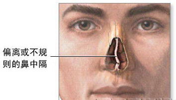 贵阳铭仁耳鼻喉医院 家长注意 孩子上课注意力不集中,竟是鼻中隔偏曲作祟