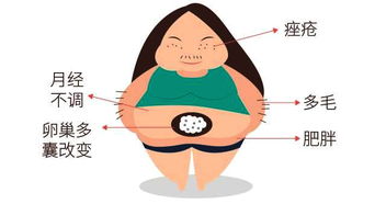 不胖也会患多囊卵巢综合征|科普时间