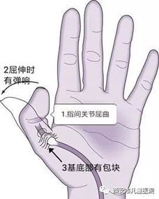 手指噼啪响 长包 伸不直,这是扳机指 还是腱鞘炎