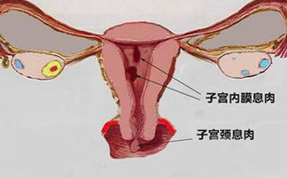 要怎样诊治宫颈息肉