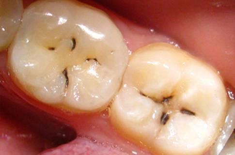 牙齿窝沟黑线怎么去除，后面下面几个大牙有黑线怎么办呢