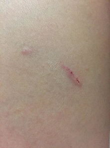被朋友家的猫咬了一口,猫没打过疫苗,一直这样没血就出来 需要打针 