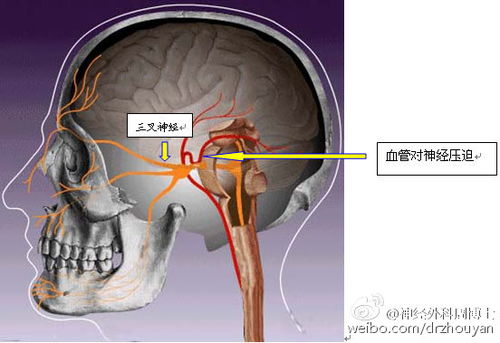 三叉神经痛 