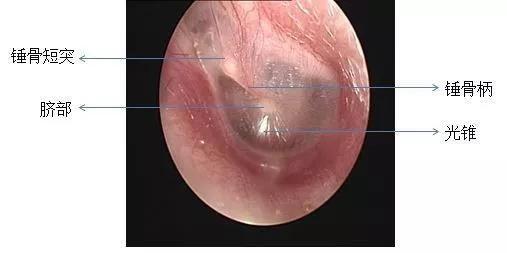 耳鼻喉医生 有这些症状,基本可以判定鼓膜穿孔,需要手术治疗