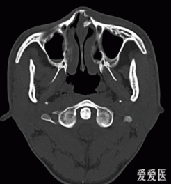 鼻子骨折骨头照片 搜狗图片搜索