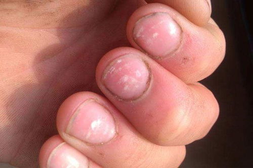 肺癌早期症状指甲图片图片