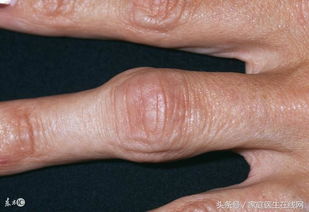 手指关节疼痛怎么办 