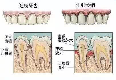 门牙缝隙那么大怎么办