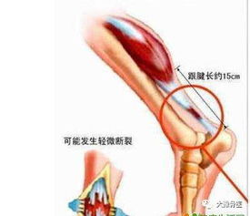 什么是跟腱,跟腱伤了怎么调理？-第3张图片