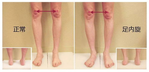 热爱跑步要当心 过度内旋 ,3个动作矫正