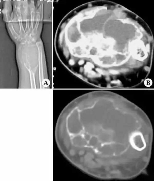 收藏 156种典型骨肌病例 X CT MR ,助你诊断无忧