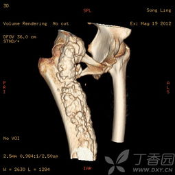 右股骨弥漫性骨皮质增厚 变形