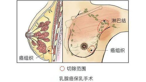 得了乳腺癌只能一切了之 不不不,保乳手术了解一下