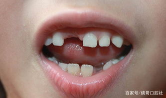 四岁小孩牙齿摔断了,可以补牙吗 需要注意什么