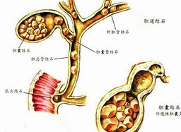 胆管结石的种类 胆管结石图 