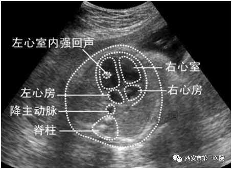 产检胎儿左心室强回声光点,怎么回事