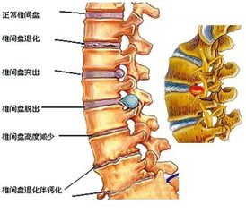 得了椎间盘突出,找不对方法后半生只能躺在床上 