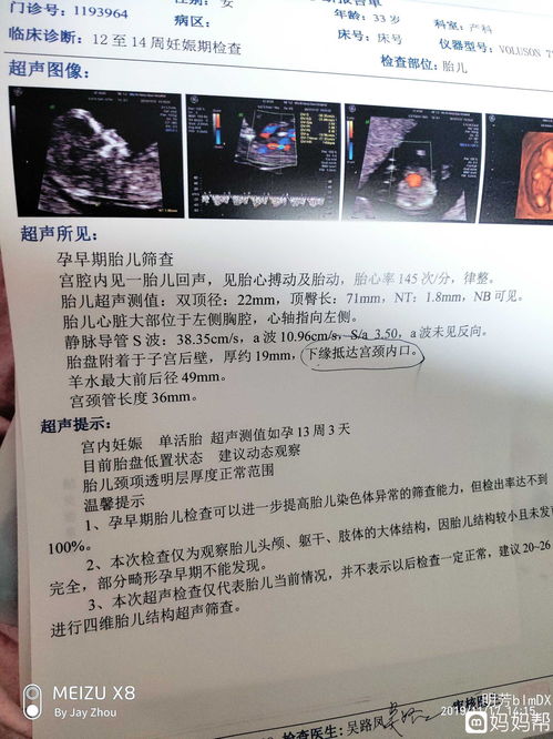 NT通过 今天12 2空腹去医院做了