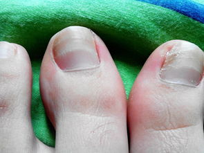 增厚型灰指甲怎么修剪,增厚型灰指甲是一种常见的指甲疾病，它通常会导致指甲变厚、变形、变色，并且可能会引起疼痛和不适