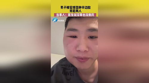 3月7日,陕西西安,男子被蜜蜂蛰肿半边脸判若两人,当事人 医生说没事也没用药