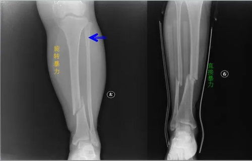 胫腓骨骨折加髌骨骨折 急症做的 米粒分享网 Mi6fx Com