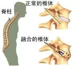 张嘉译 周杰伦都患上的强直性脊椎炎,究竟是怎么回事 