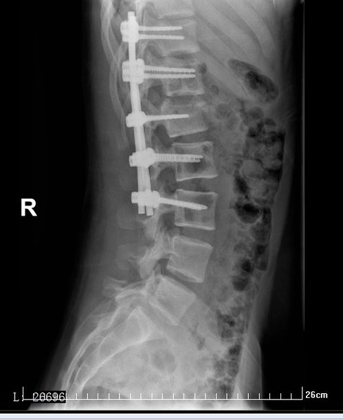 腰椎椎弓骨折 搜狗图片搜索