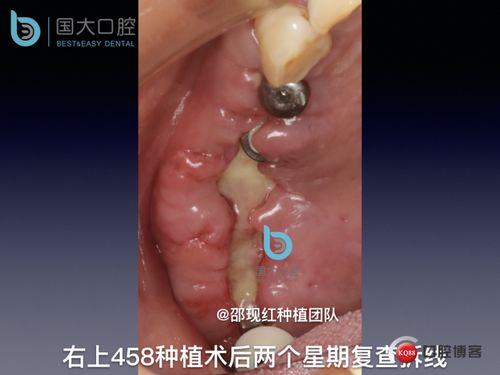 种植术后牙龈软组织愈合方式长期临床观察