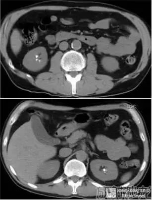 病例挑战第219期 CT增强扫描尿路造影,图1CT增强扫描尿路造影 附右肾插图 ,,图2双肾轴位CT平扫,最可能的诊断是什么
